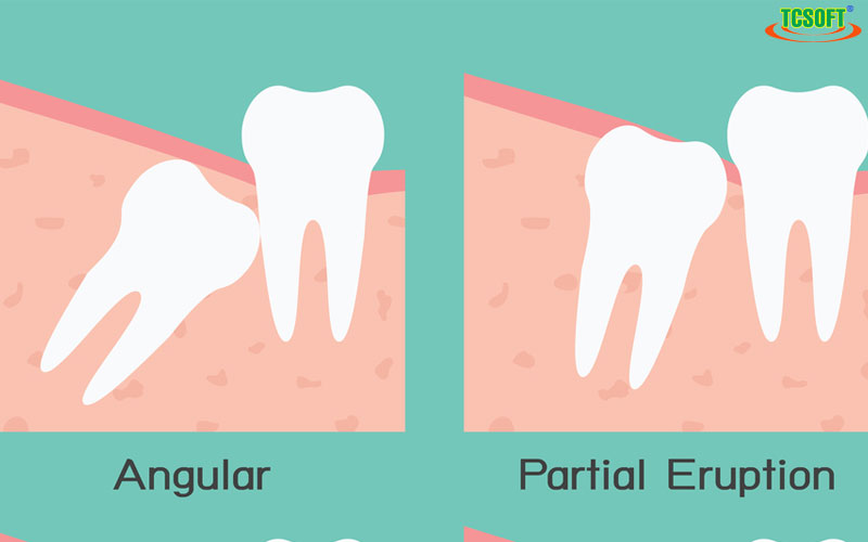 Hậu quả nặng nề nếu không biết cách chữa trị răng khôn